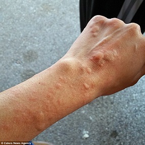 exposure to the cold air would trigger an outbreak of hives on her face, arms and body