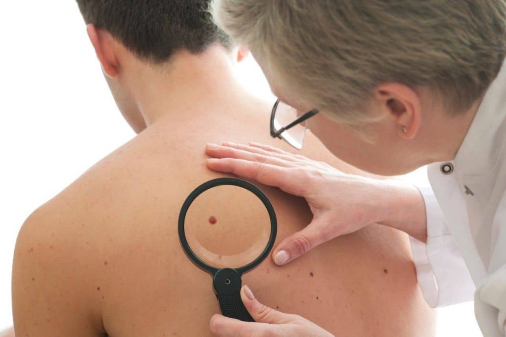 Skin Tag Removal : How To Remove Skin Tags At Home